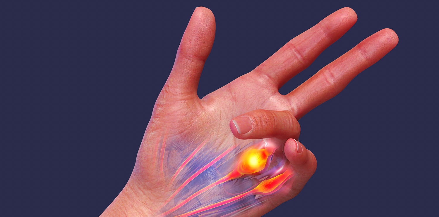 Dupuytren syndrome hand hubspot