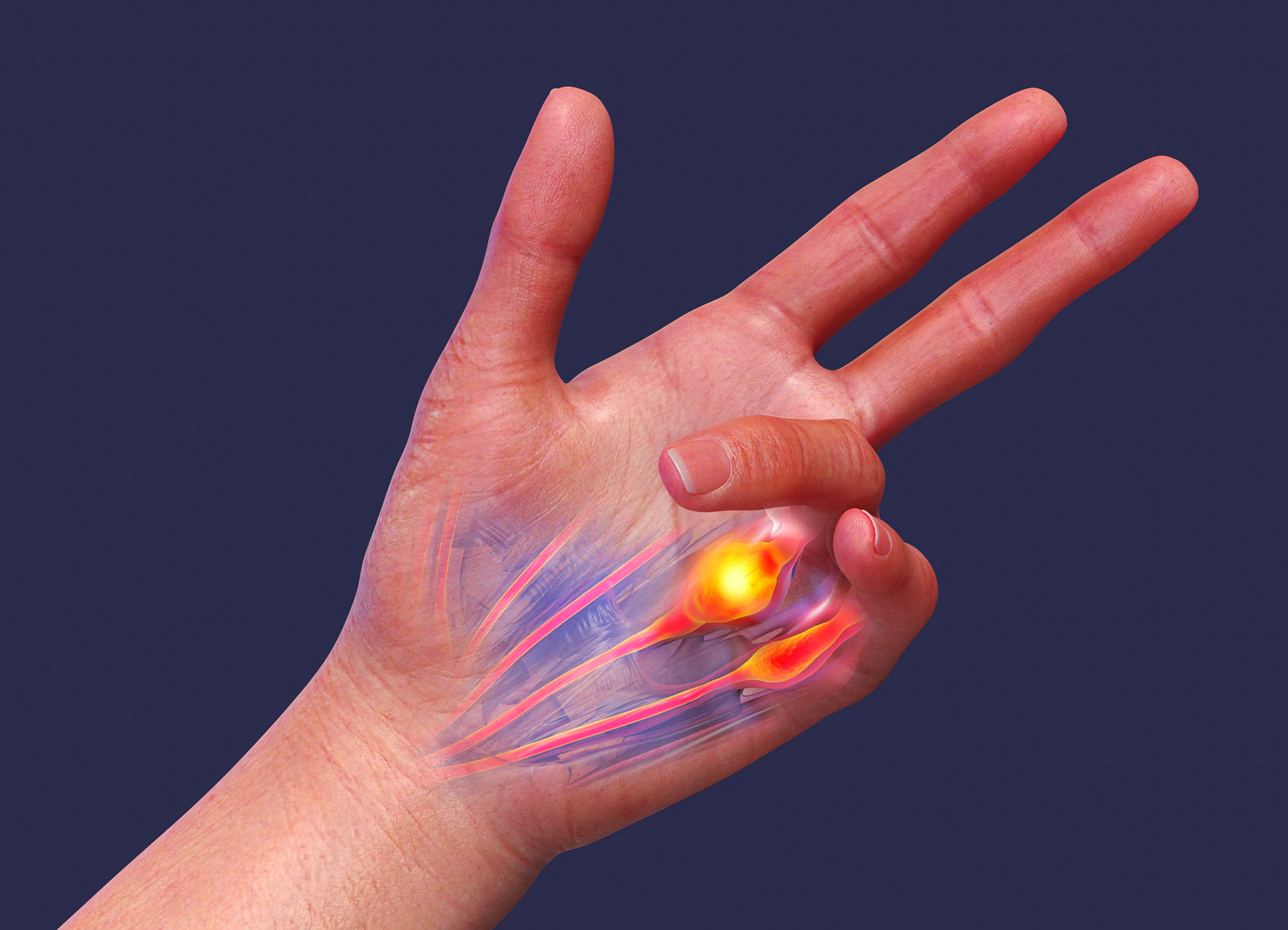 Dupuytren syndrome hand website